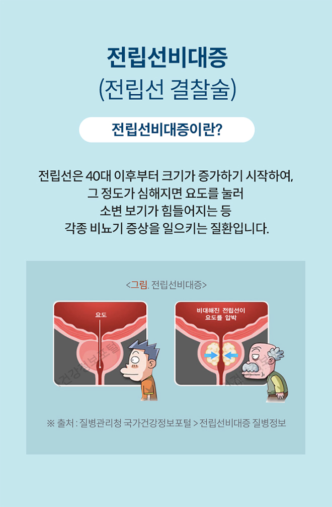 전립선비대증(전립선 결찰술)