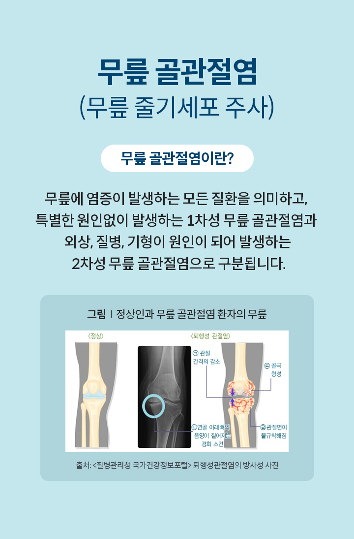 무릎 골관절염(무릎 줄기세포 주사)