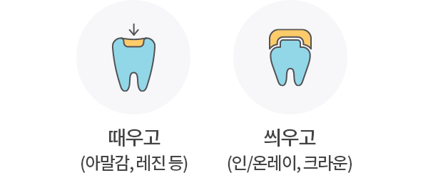 때우고(아말감, 레진 등), 씌우고(인/온레이, 크라운)