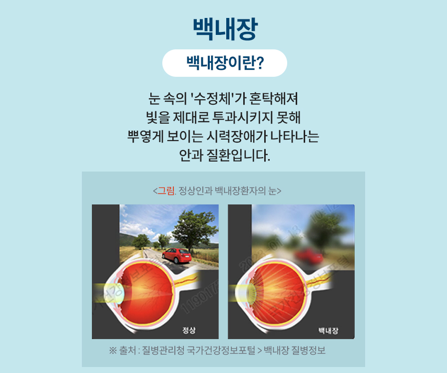 백내장이란?눈속의 '수정체'가 혼탁해져 빛을 제대로 투과시키지 못해 뿌옇게 보이는 시력장애가 나타나는 안과 질환입니다.