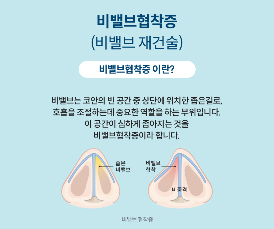 비밸브협착증(비밸브재건술) 비밸브협착증 이란? 비밸브는 코안의 빈 공간 중 상단에 위치한 좁은길로, 호흡을 조절하는데 중요한 역할을 하는 부위입니다. 이 공간이 심하게 좁아지는 것을 비밸브협착증이라 합니다.