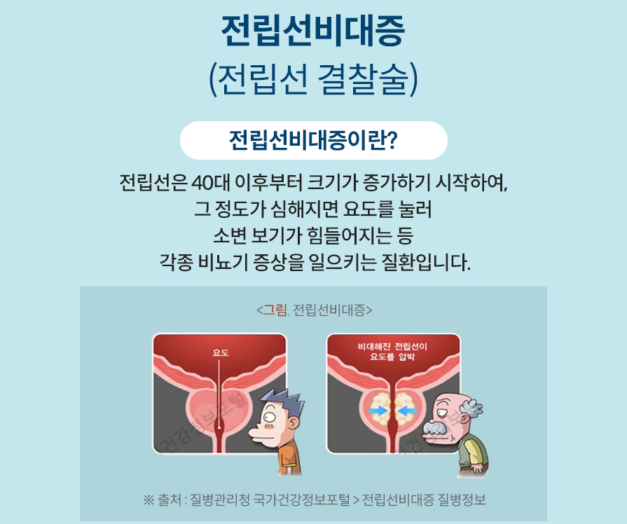 전립선비대증 (전립선 결찰술) 전립선비대증이란? 전립선은 40대 이후부터 크기가 증가하기 시작하여, 그 정도가 심해지면 요도를 눌러 소변 보기가 힘들어지는 등 각종 비뇨기 증상을 일으키는 질환입니다.